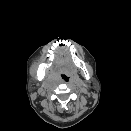 Bisphosphonate-related osteonecrosis of the jaw (Radiopaedia 71324-81642 non-contrast 65).jpg