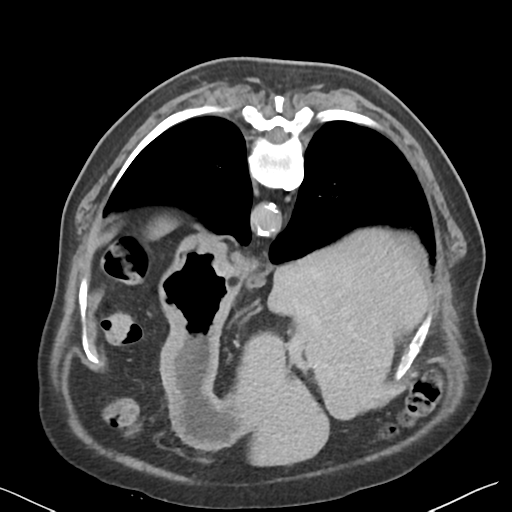 File:Bladder papillary urothelial carcinoma (Radiopaedia 48119-52951 Axial C+ delayed 1).png