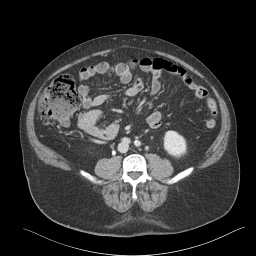 File:Bladder papillary urothelial carcinoma (Radiopaedia 48119-52951 C 1).png
