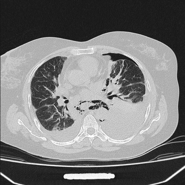 Boerhaave syndrome (Radiopaedia 45644-49799 Axial lung window 65).jpg