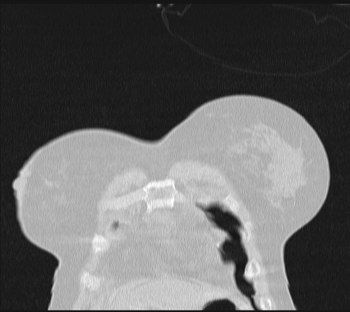 Boerhaave syndrome (Radiopaedia 45644-49799 Coronal lung window 7).jpg