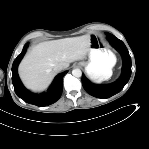 Bone metastasis from squamous cell carcinoma (Radiopaedia 30133-30730 B 12).jpg