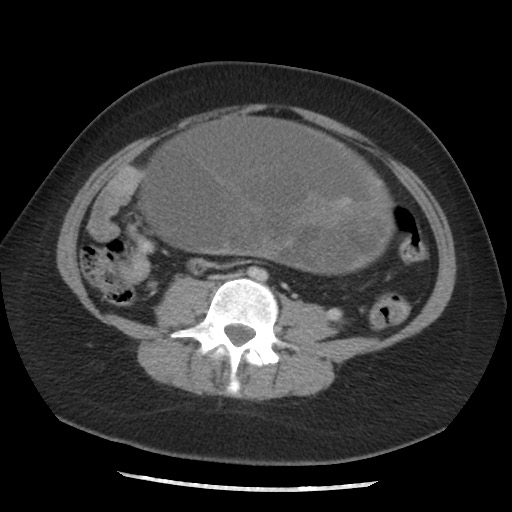 File:Borderline mucinous tumor (ovary) (Radiopaedia 78228-90808 A 99).jpg