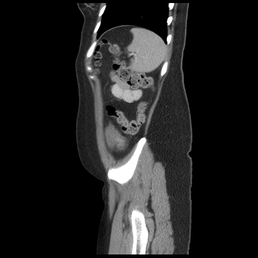 File:Borderline mucinous tumor (ovary) (Radiopaedia 78228-90808 B 55).jpg