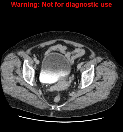 Bosniak renal cyst - type II (Radiopaedia 23404-23468 F 59).jpg