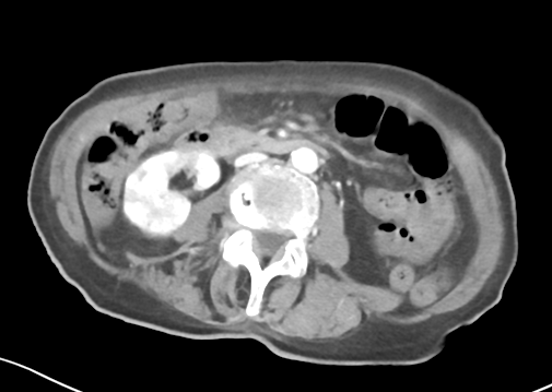 File:Bowel ischemia (Radiopaedia 58273-65382 A 29).png