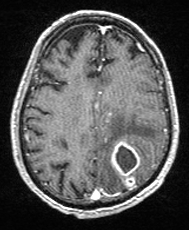 Brain abscess with dual rim sign (Radiopaedia 87566-103938 Axial T1 C+ 115).jpg