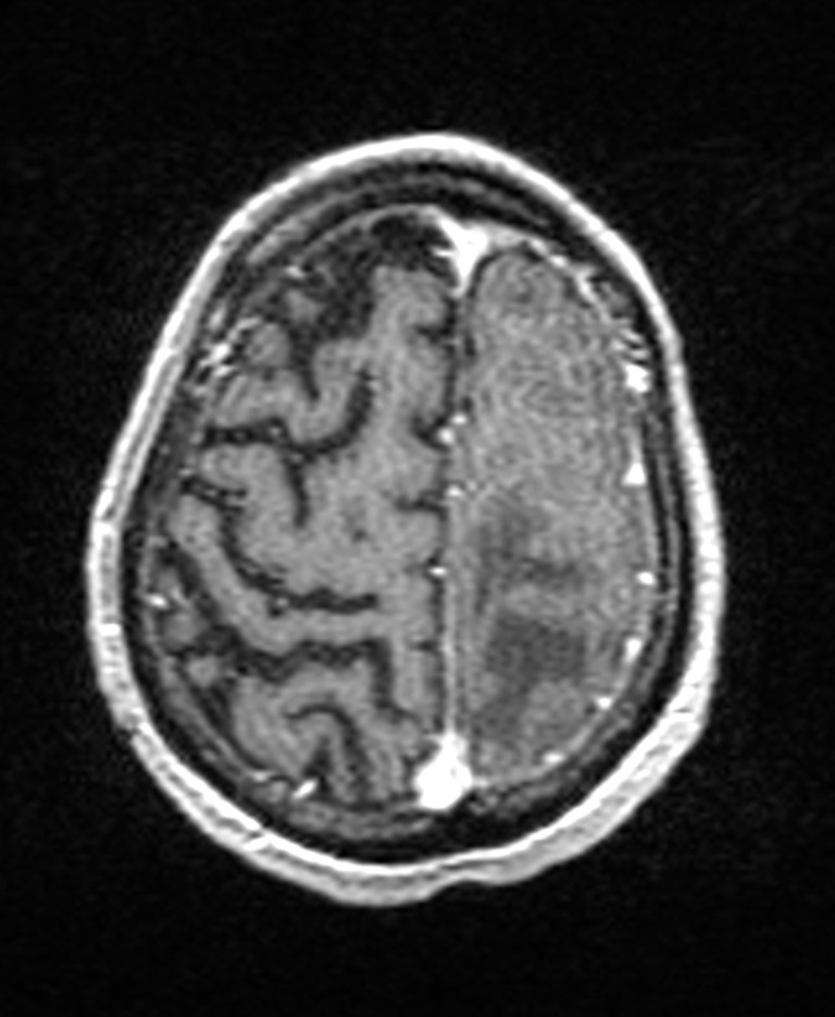 Brain abscess with dual rim sign (Radiopaedia 87566-103938 Axial T1 C+ 134).jpg