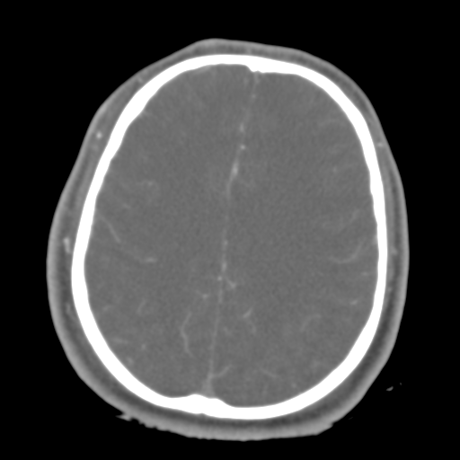 Brain contusions, internal carotid artery dissection and base of skull fracture (Radiopaedia 34089-35339 D 17).png