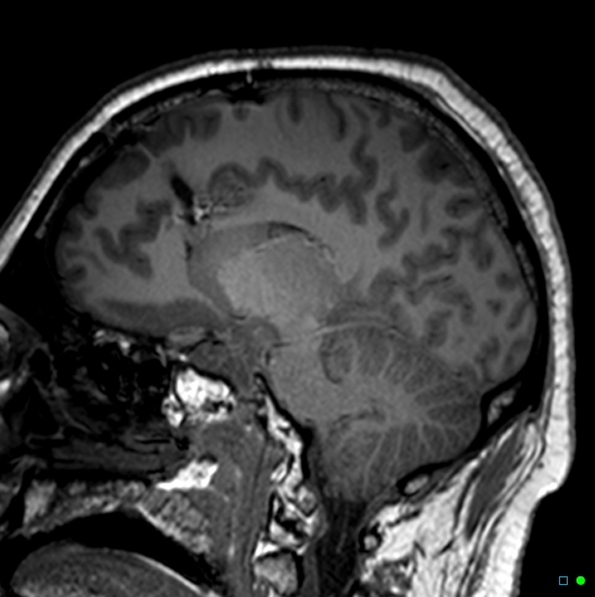 Brain death on MRI and CT angiography (Radiopaedia 42560-45689 Sagittal T1 36).jpg