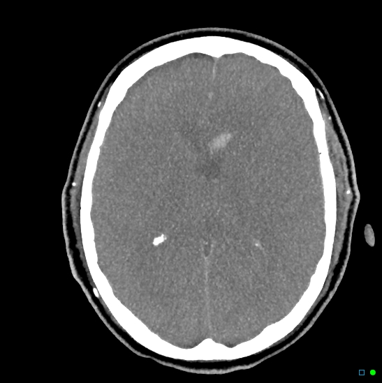 Brain death on MRI and CT angiography (Radiopaedia 42560-45841 B 25).jpg