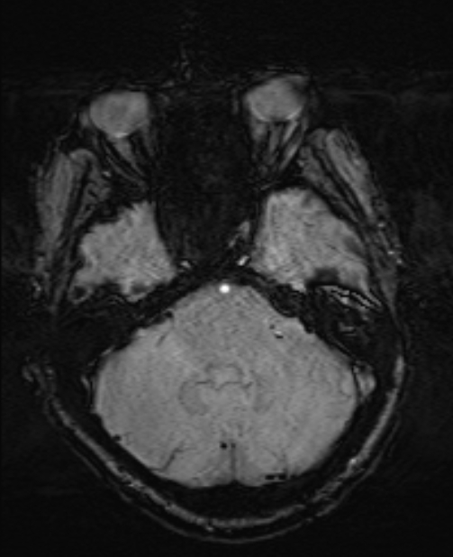 Brain metastases - lung cancer primary (Radiopaedia 75060-86115 Axial SWI 17).jpg