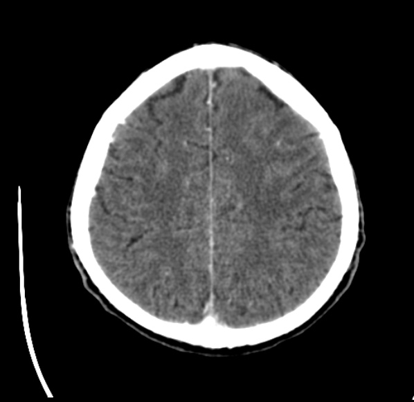 File:Brain metastases from lung cancer (Radiopaedia 24480-24781 Axial C+ delayed 47).jpg