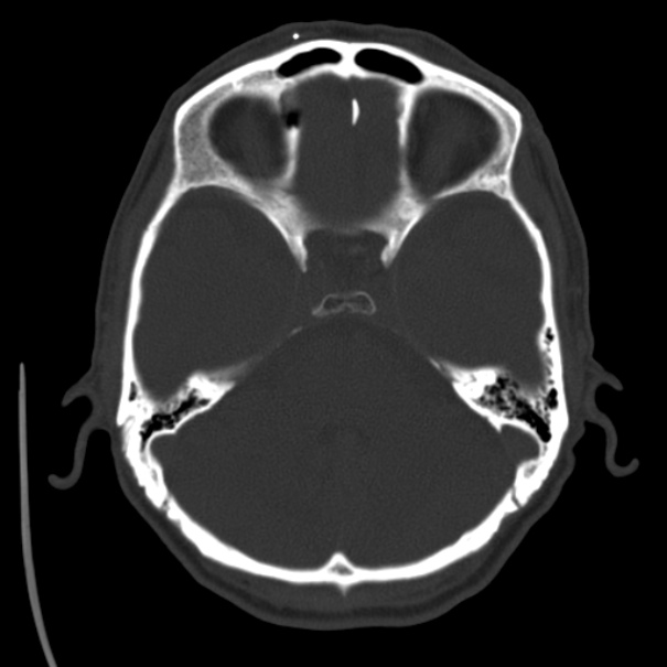 Brain metastases from lung cancer (Radiopaedia 24480-24781 Axial bone window 13).jpg