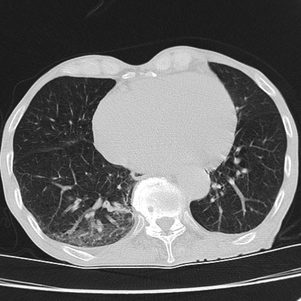 Brain metastases from lung cancer (Radiopaedia 27849-28093 Axial lung window 47).jpg