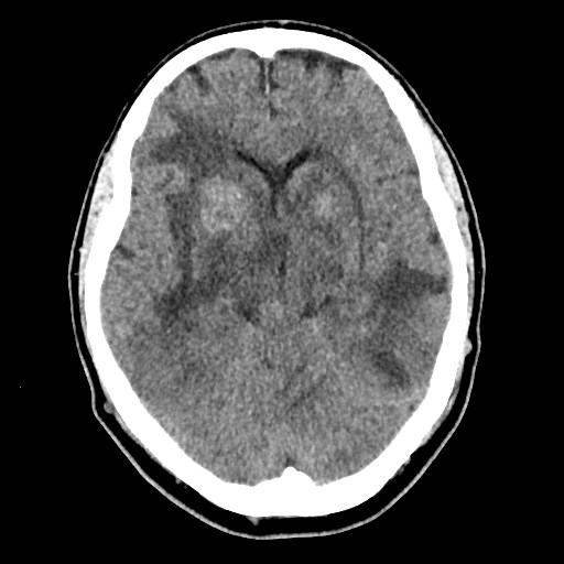 File:Brain metastases from lung cancer (Radiopaedia 83839-99027 Axial non-contrast 15).jpg