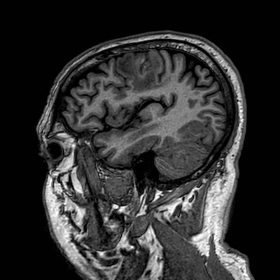 Brain metastases from lung cancer (Radiopaedia 83839-99028 Sagittal T1 102).jpg