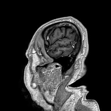 Brain metastases from lung cancer (Radiopaedia 83839-99028 Sagittal T1 C+ 3).jpg