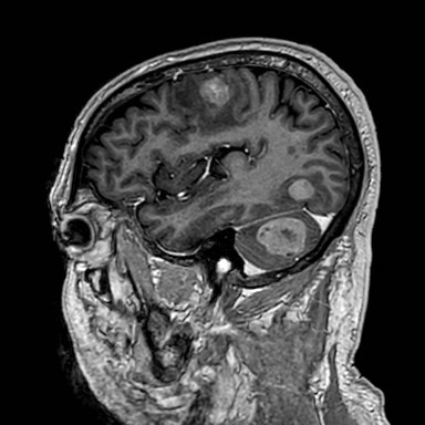 Brain metastases from lung cancer (Radiopaedia 83839-99028 Sagittal T1 C+ 50).jpg