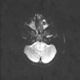 Brainstem glioma (Radiopaedia 67531-76922 Axial DWI 29).jpg