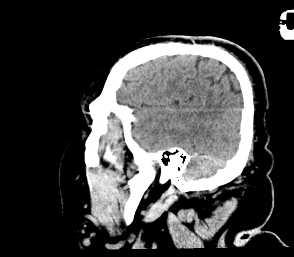 Brainstem hemorrhage (Radiopaedia 81294-94976 C 48).jpg
