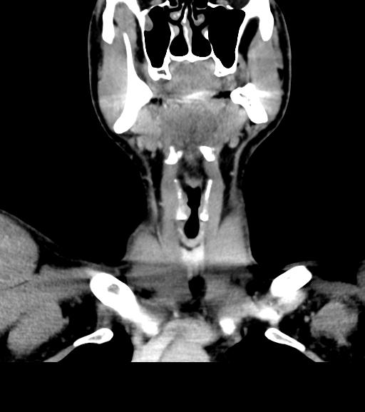 Branchial cleft cyst (Radiopaedia 31167-31875 Coronal C+ delayed 24).jpg