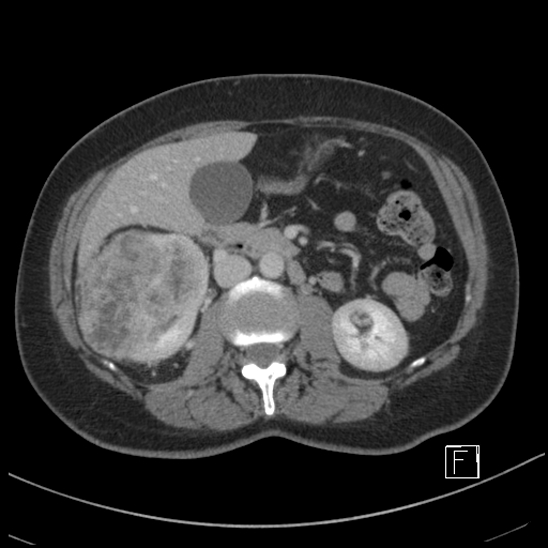 Breast metastases from renal cell cancer (Radiopaedia 79220-92225 C 43).jpg