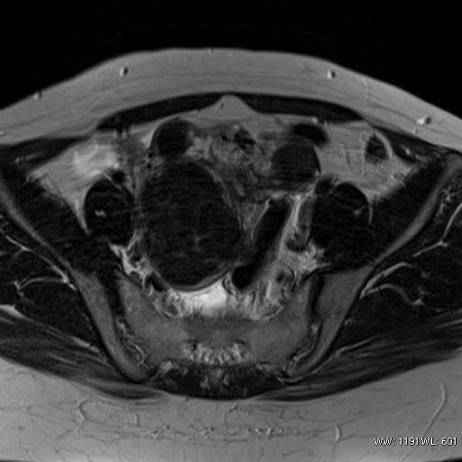 File:Broad ligament fibroid (Radiopaedia 49135-54241 Axial T2 13).jpg