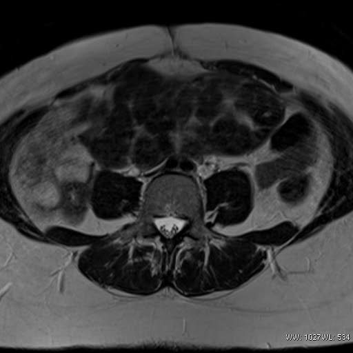 File:Broad ligament fibroid (Radiopaedia 49135-54241 Axial T2 3).jpg