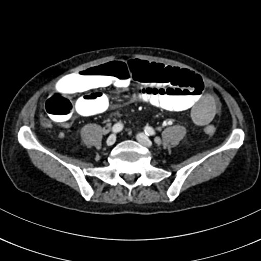 File:Broad ligament hernia (Radiopaedia 84802-100276 A 69).jpg