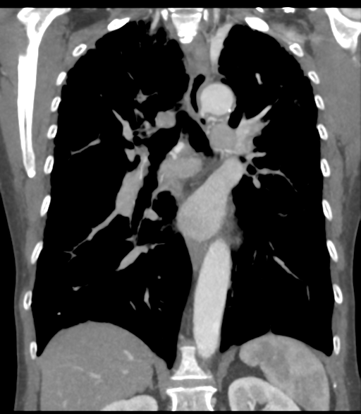 File:Bronchial artery aneurysms (Radiopaedia 42282-45385 Coronal C+ delayed 39).png
