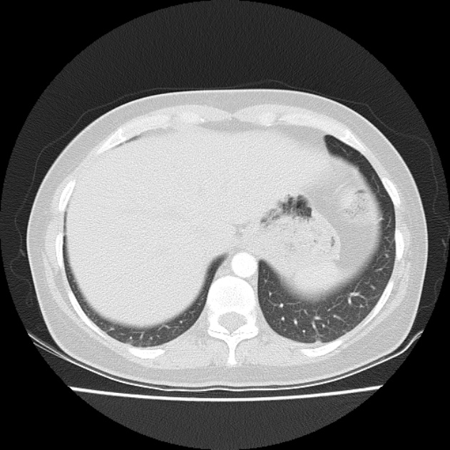 Bronchial atresia (Radiopaedia 22965-22992 Axial lung window 10).jpg