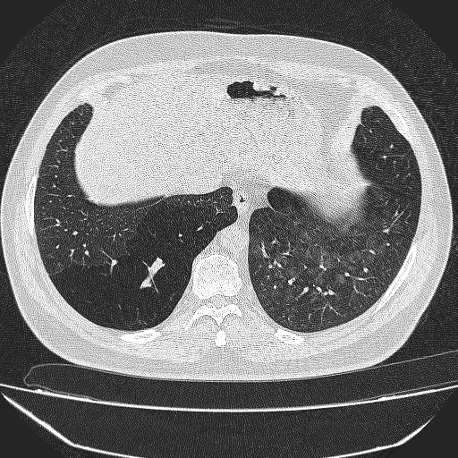 File:Bronchial atresia (Radiopaedia 58271-65417 Axial lung window 39).jpg