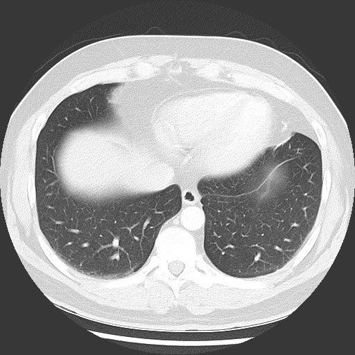 Bronchial carcinoid tumor (Radiopaedia 67377-76764 Axial lung window 47).jpg