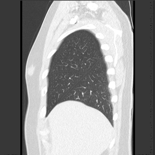 File:Bronchial carcinoid tumor (Radiopaedia 67377-76764 Sagittal lung window 12).jpg