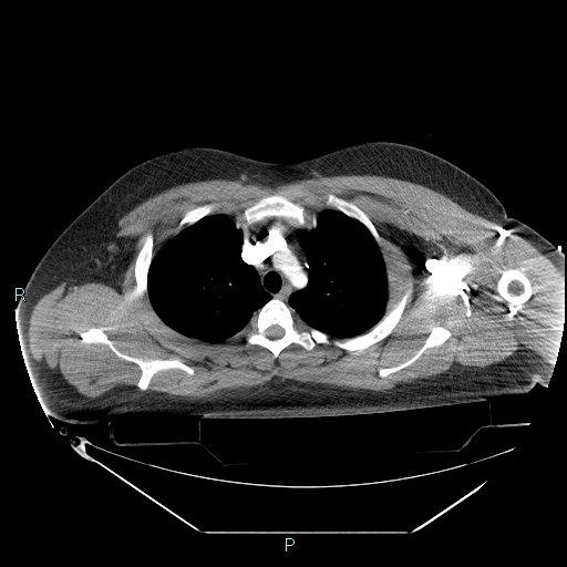 Bronchial carcinoid tumor (Radiopaedia 78272-90870 B 34).jpg