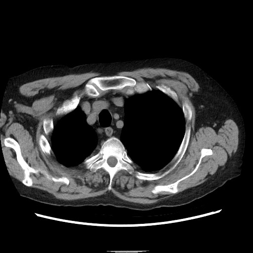 Bronchial stenosis - lung transplant (Radiopaedia 73133-83848 Axial non-contrast 12).jpg