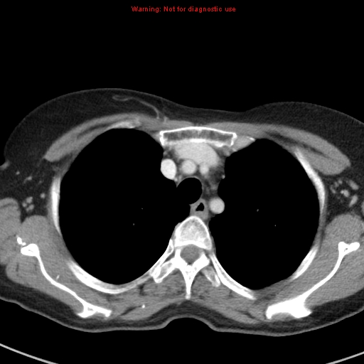 File:Bronchoalveolar carcinoma (BAC) (Radiopaedia 13436-13392 B 12).jpg