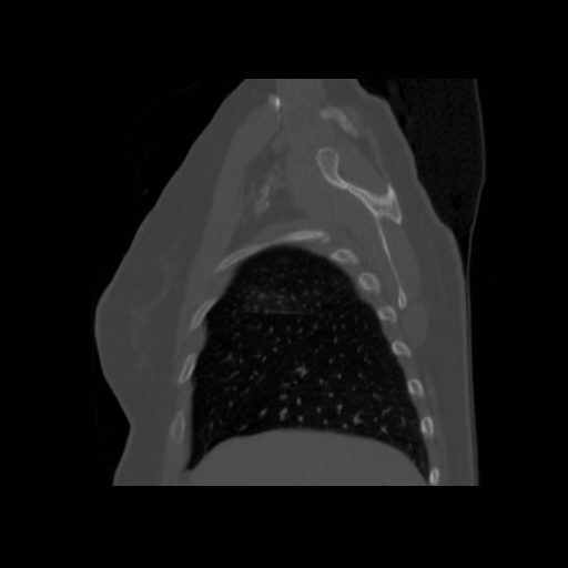 Bronchogenic carcinoma (Radiopaedia 73497-84262 Sagittal bone window 37).jpg