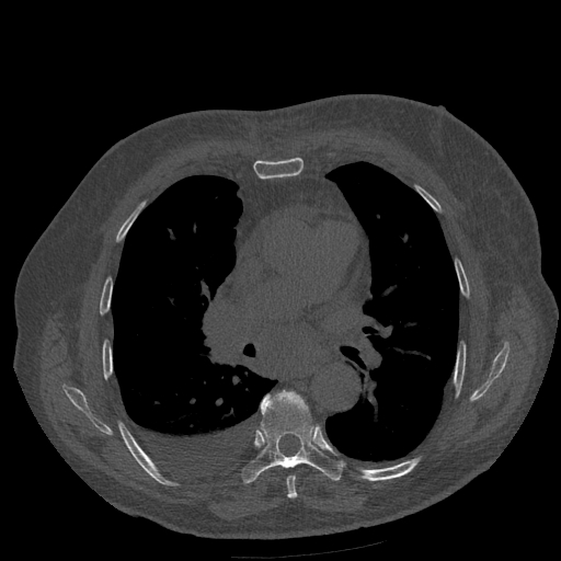 Bronchogenic carcinoma with metastatic lymphadenopathy (Radiopaedia 37671-39569 Axial bone window 28).jpg
