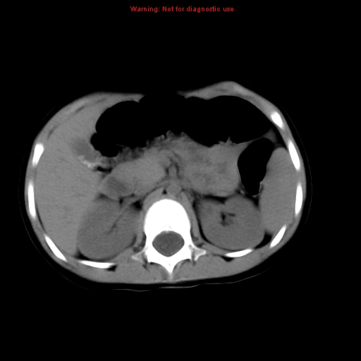 File:Bronchogenic cyst (Radiopaedia 9372-10063 Axial non-contrast 20).jpg
