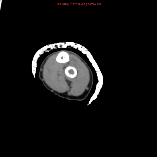 File:Brown tumor (Radiopaedia 12460-12694 Axial non-contrast 110).jpg