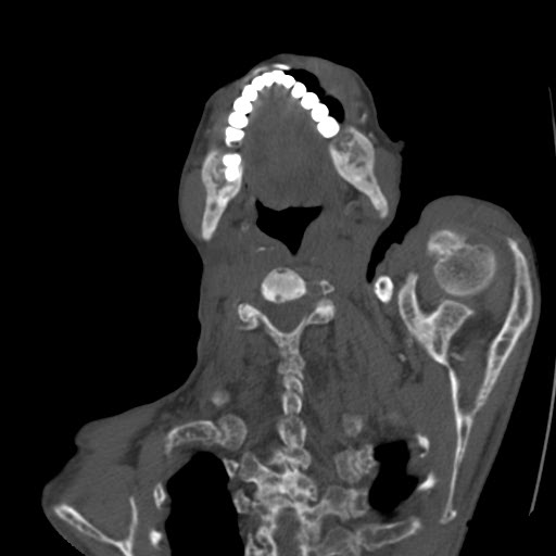 File:Brown tumor with secondary hyperparathyroidism (Radiopaedia 23591-23705 C 16).jpg