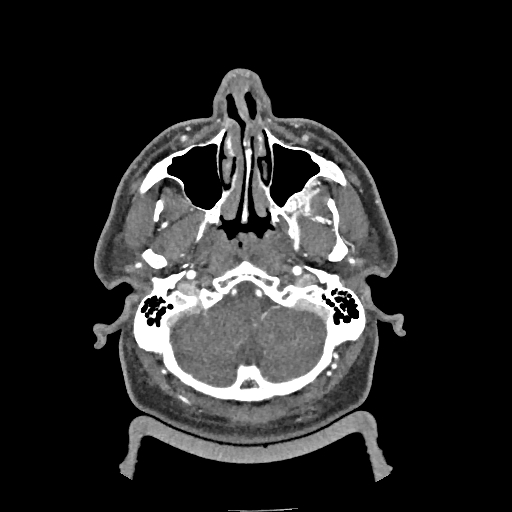 Buccal fat pad arteriovenous malformation (Radiopaedia 70936-81144 D 237).jpg