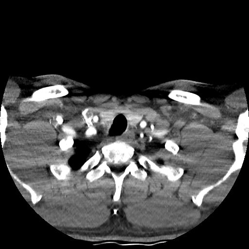 Buccal fat pad arteriovenous malformation (Radiopaedia 70936-81144 D 44).jpg