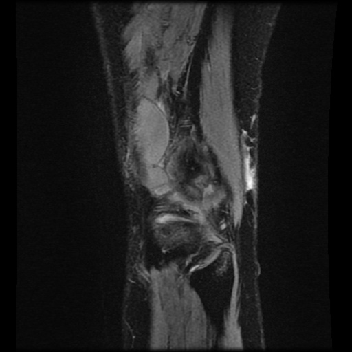 Bucket handle meniscus tear (Radiopaedia 56916-63751 H 5).jpg