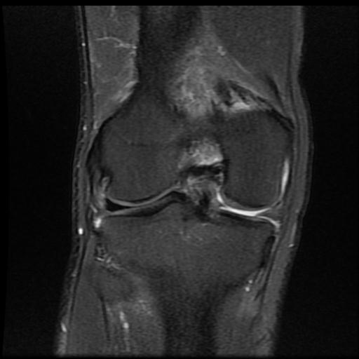 File:Bucket handle tear - medial meniscus (Radiopaedia 69245-79026 Coronal PD fat sat 13).jpg