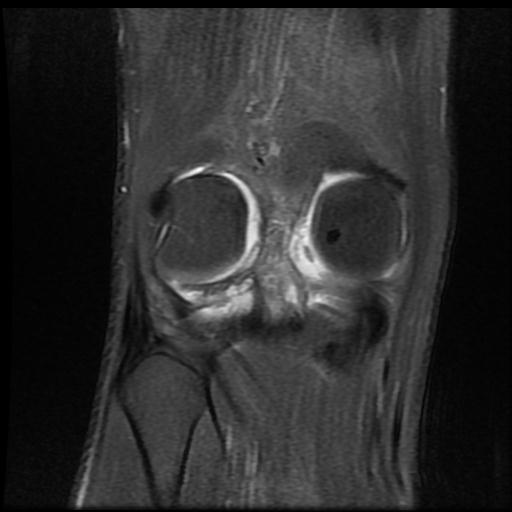 File:Bucket handle tear - medial meniscus (Radiopaedia 69245-79026 Coronal PD fat sat 16).jpg