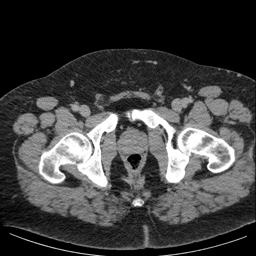 Burned-out testicular seminoma - retroperitoneal nodal metastases (Radiopaedia 62872-71245 A 71).jpg