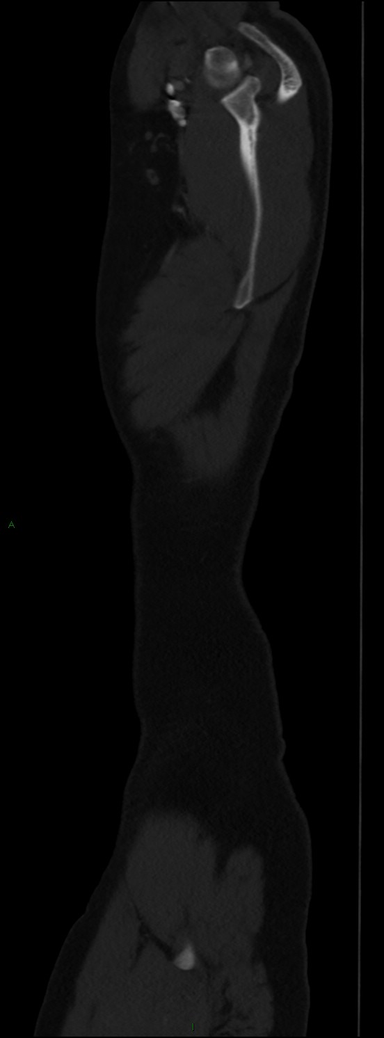 Burst fracture (Radiopaedia 83168-97542 Sagittal bone window 20).jpg